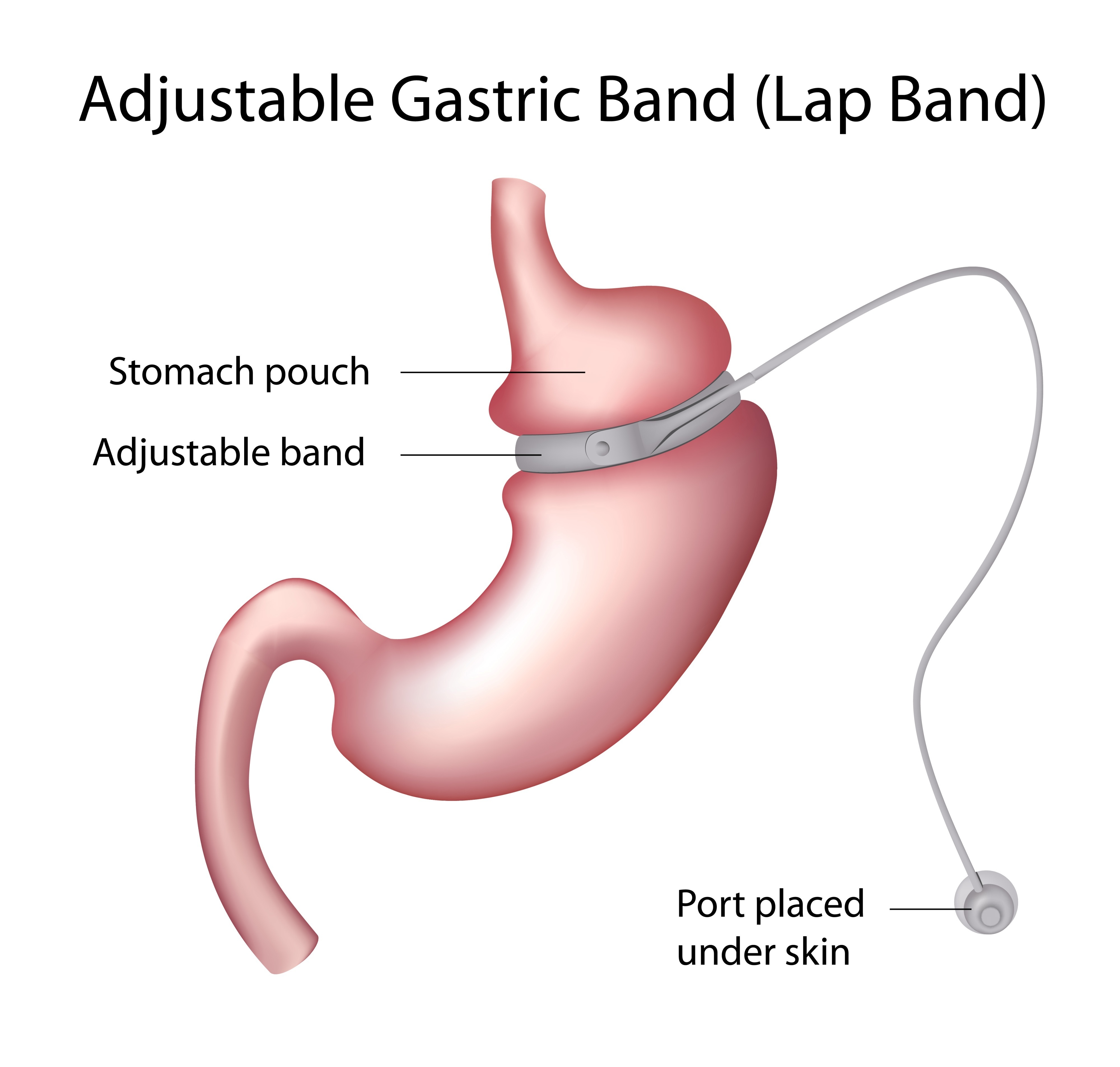 Cheapest gastric band surgery uk
