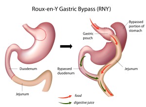 Laparoscopic Gastric Bypass ReY